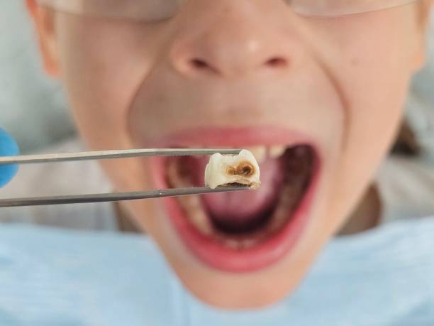 Best Emergency Dental Care for Abscessed Tooth in Delevan, NY
